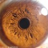 eyecancer